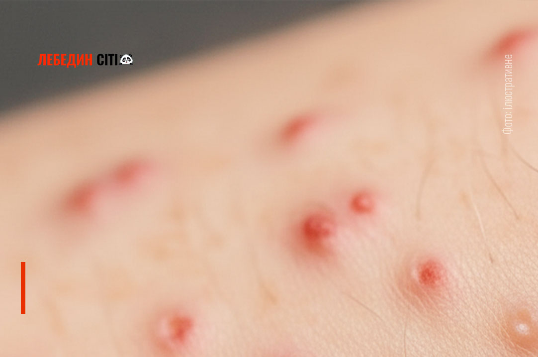 Епідемічна ситуація на Лебединщині за тиждень (08.12 – 14.12.2025)