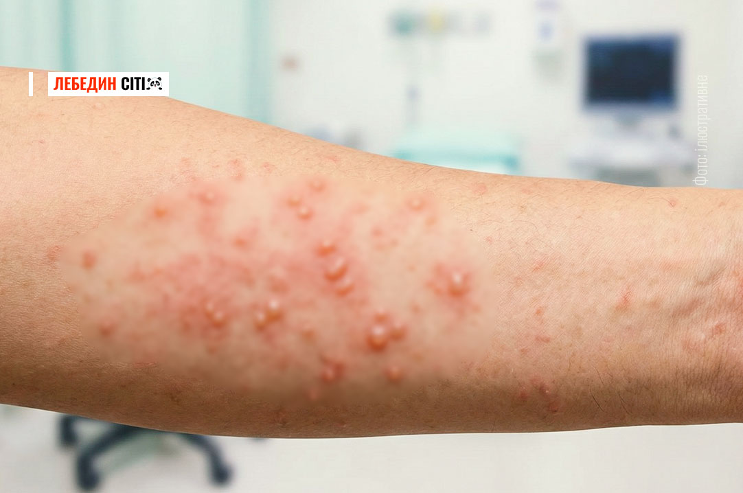 У Лебединській громаді зростає захворюваність на вітряну віспу